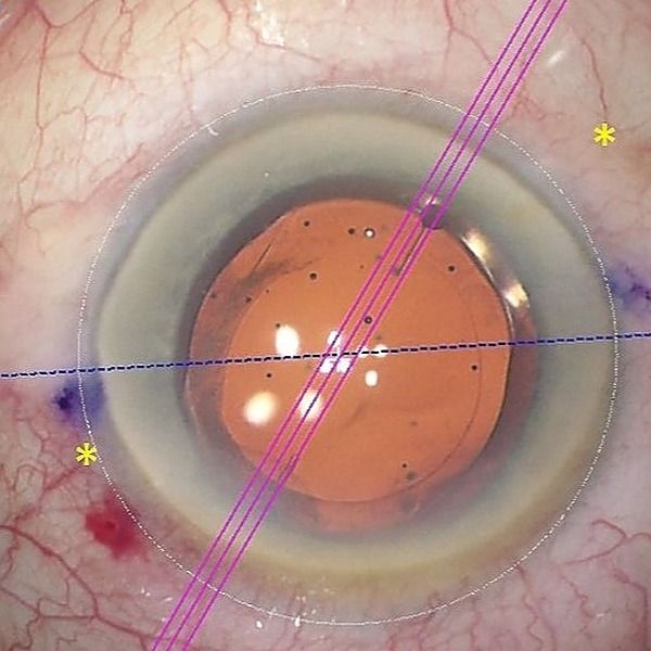 Bon usage des implants toriques dans la chirurgie de la cataracte