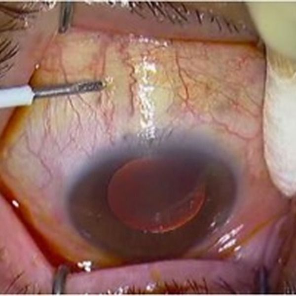 Hypertonie oculaire après injection intravitréenne dans la DMLA et le diabète