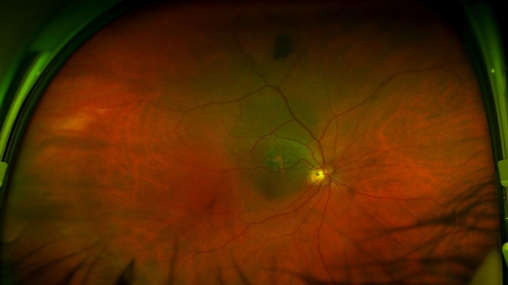 Apports de l’imagerie multimodale du segment postérieur en cancérologie oculaire